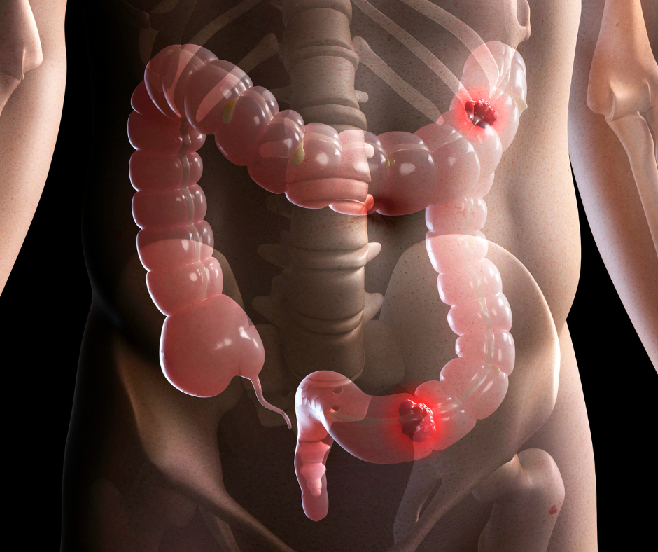 Visualización 3D del intestino grueso sobre un esqueleto humano mostrando áreas dañadas por enfermedad inflamatoria intestinal